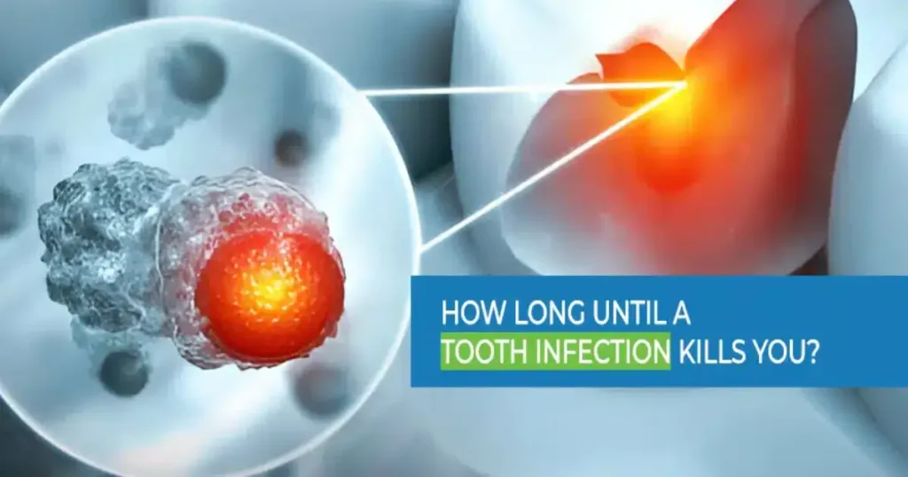 How Long Until a Tooth Infection Kills You?