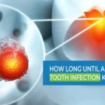 How Long Until a Tooth Infection Kills You?